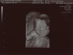 24th week ultrasound